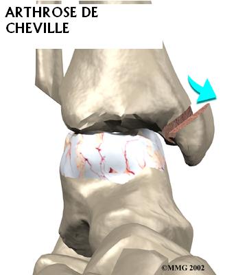 Arthrod se Centre Orthop dique Pasteur Lanroze